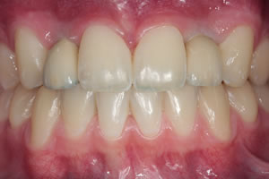 nichtanlage von Zähnen